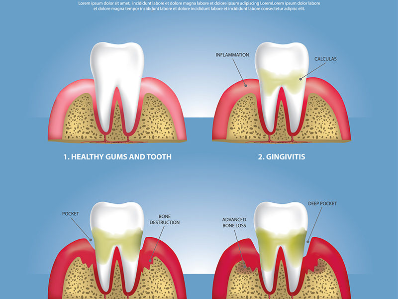 Gum Disease: Everything you need to know