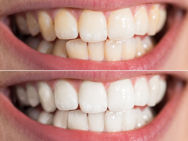 At-Home vs. In-Clinic Tooth Whitening