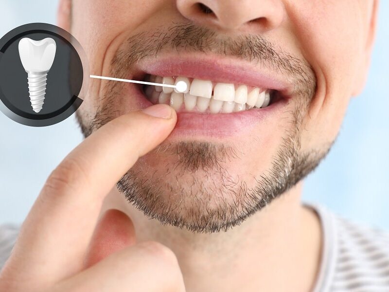 How to Choose and Work With a Dentist for Dental Implants