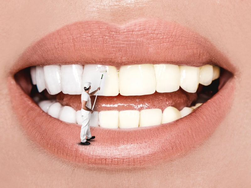The Unknown Risks Of Home Tooth Whitening