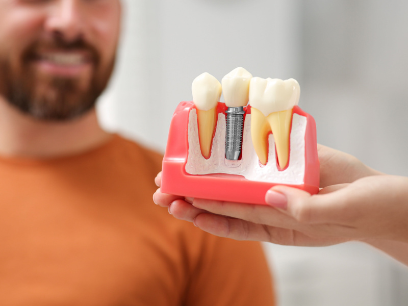 10 Myths About Dental Implants