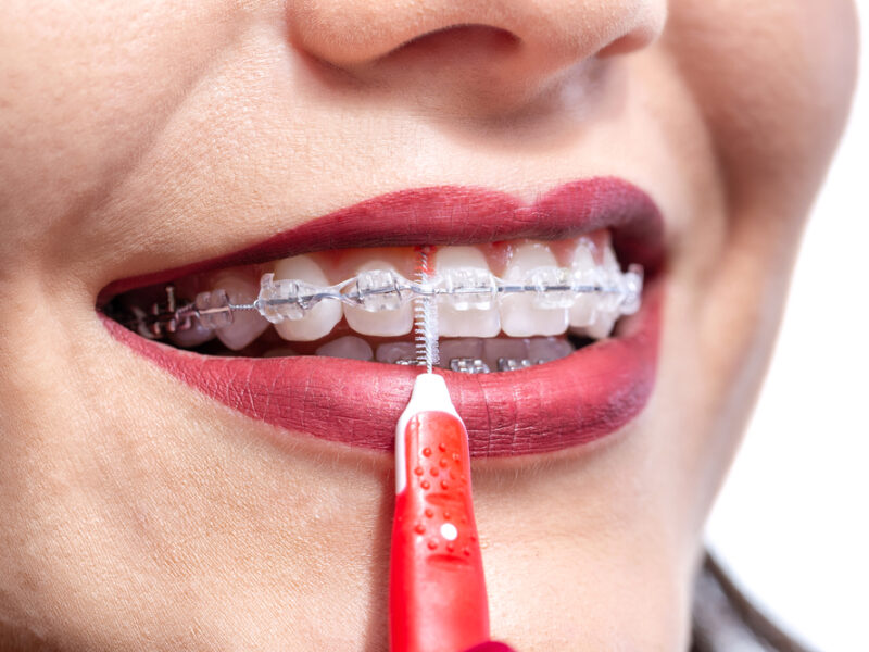 How to Maintain Your Braces