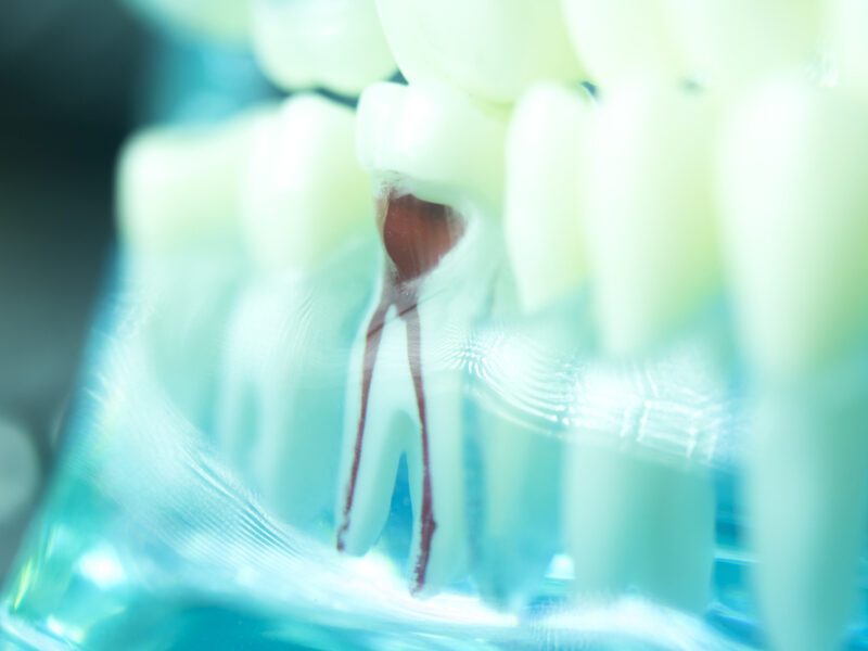 Dental,Tooth,Root,Canal,Dentists,Teeth,Model,Closeup.